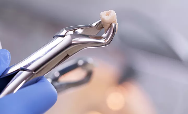 抜歯（必要な場合）