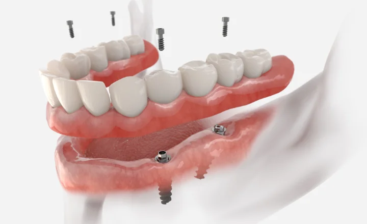 最終的な人工歯の作製・装着