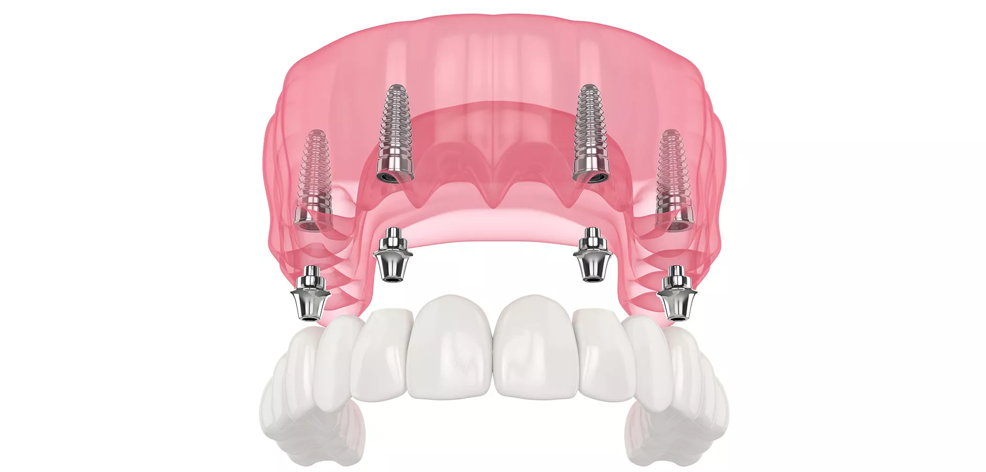 All-on-4（オールオン4）とは？
