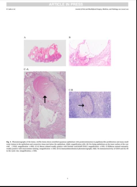アジア口腔外科学会誌「Journal of Oral and Maxilofacial Surgery, Medicine, and Pathology」に当院Drが執筆した論文が掲載されました。
